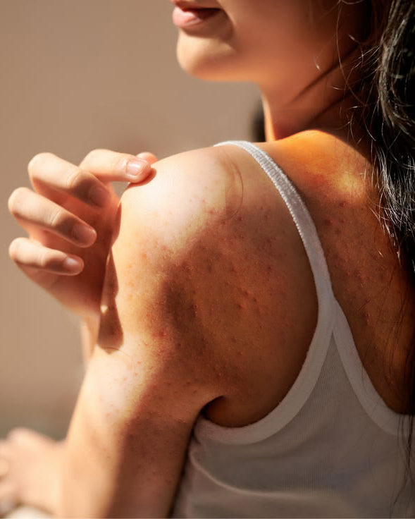 Body Acne & Blemishes