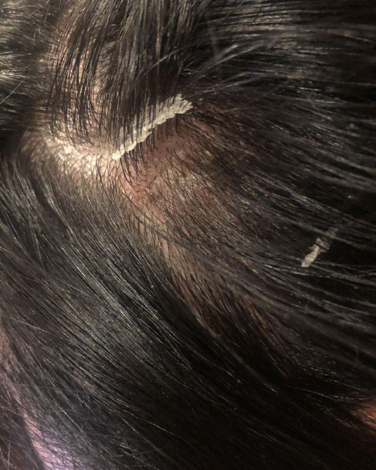 Dry Dandruff & Dry Scalp