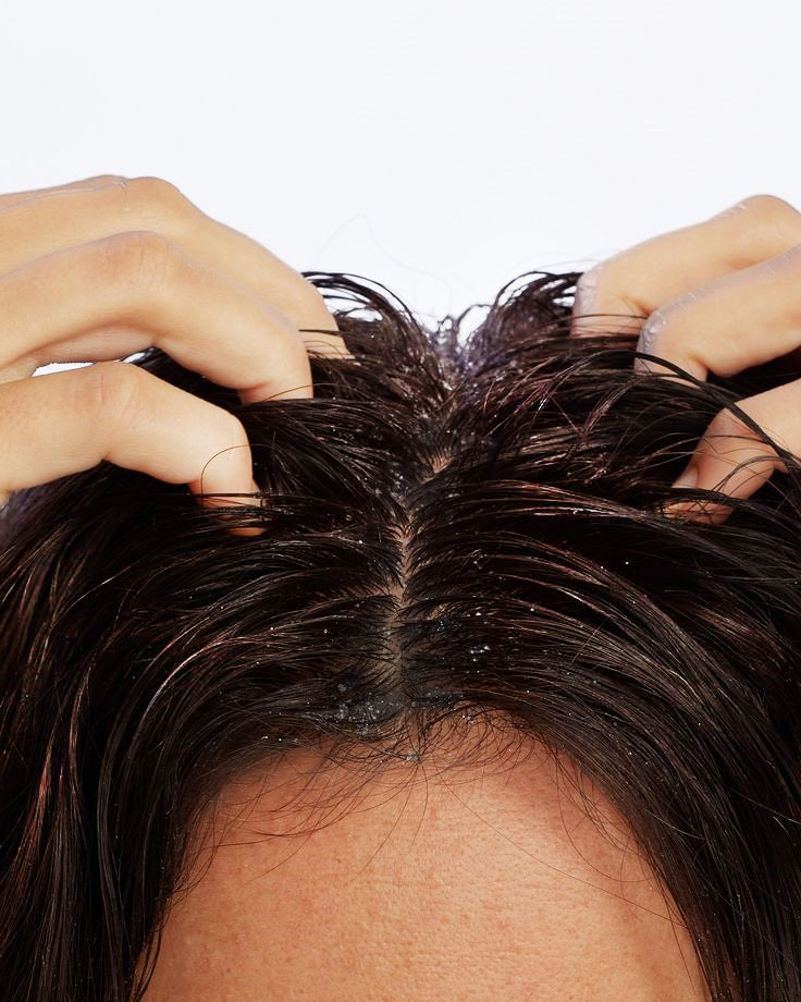 Oily Dandruff & Oily Scalp