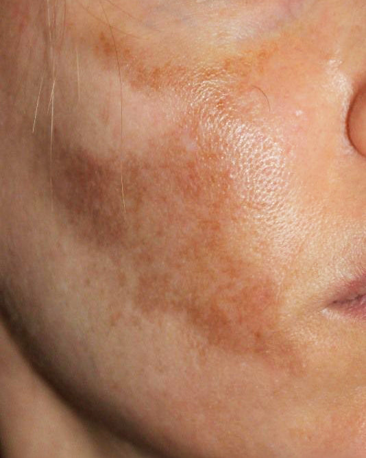 Pigmentation & Even Tone