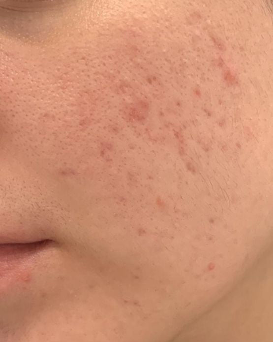 Pores & Blackheads
